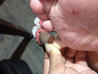 脚上起小水泡还很痒是什么原因(脚上起小水泡很痒是什么原因引起的)