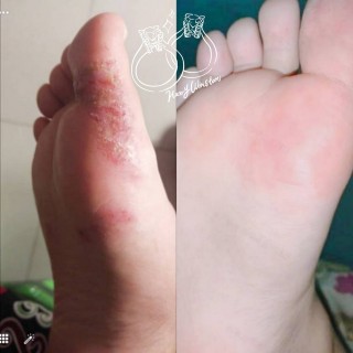 脚上起小水泡还很痒是怎么回事(脚上起小水泡还很痒是怎么回事用什么药)