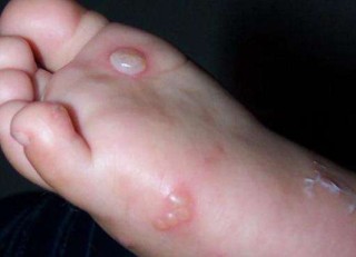 脚上起小水泡还很痒是怎么回事(脚上起小水泡还很痒是怎么回事用什么药)