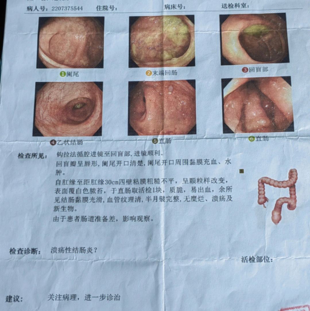 克罗恩病和溃疡性结肠炎的区别(克罗恩病与溃疡性结肠炎的鉴别诊断)  第2张